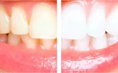 Blanqueamiento dental: Descubre cómo lograr dientes más blancos y brillantes