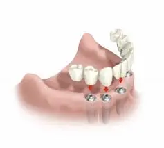 Implantes dentales - ABCDental Sants