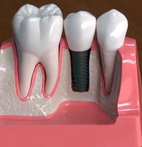 Implantes dentales - ABCDental Sants