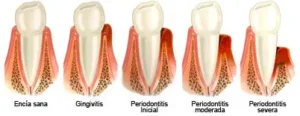 periodoncia - ABCDental Sants
