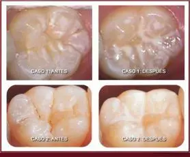 Odontología preventiva - ABCDental Sants